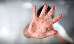 СЗО и УНИЦЕФ предупреждават за риск от световна епидемия от морбили