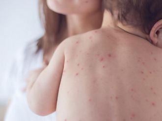 Заради бума на варицела - ваксината е напът да стане задължителна и у нас